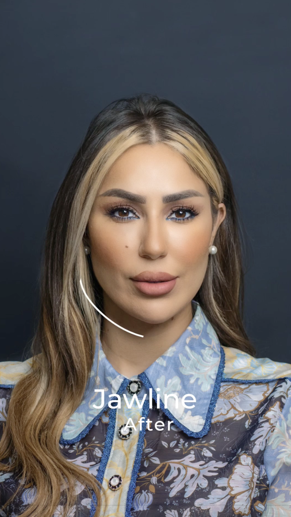 Face Remodeling · Jawline Sculpt, after