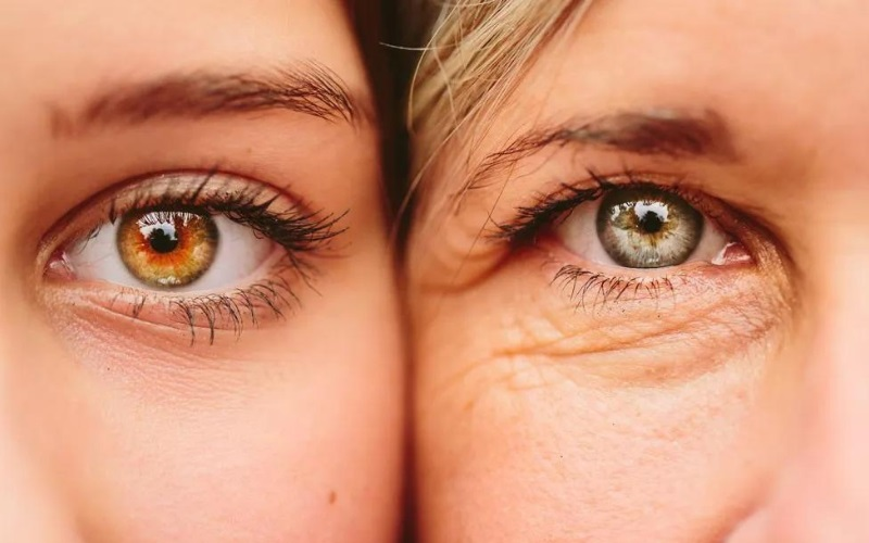 Under-Eye Treatment treatment with Dr. Azmal