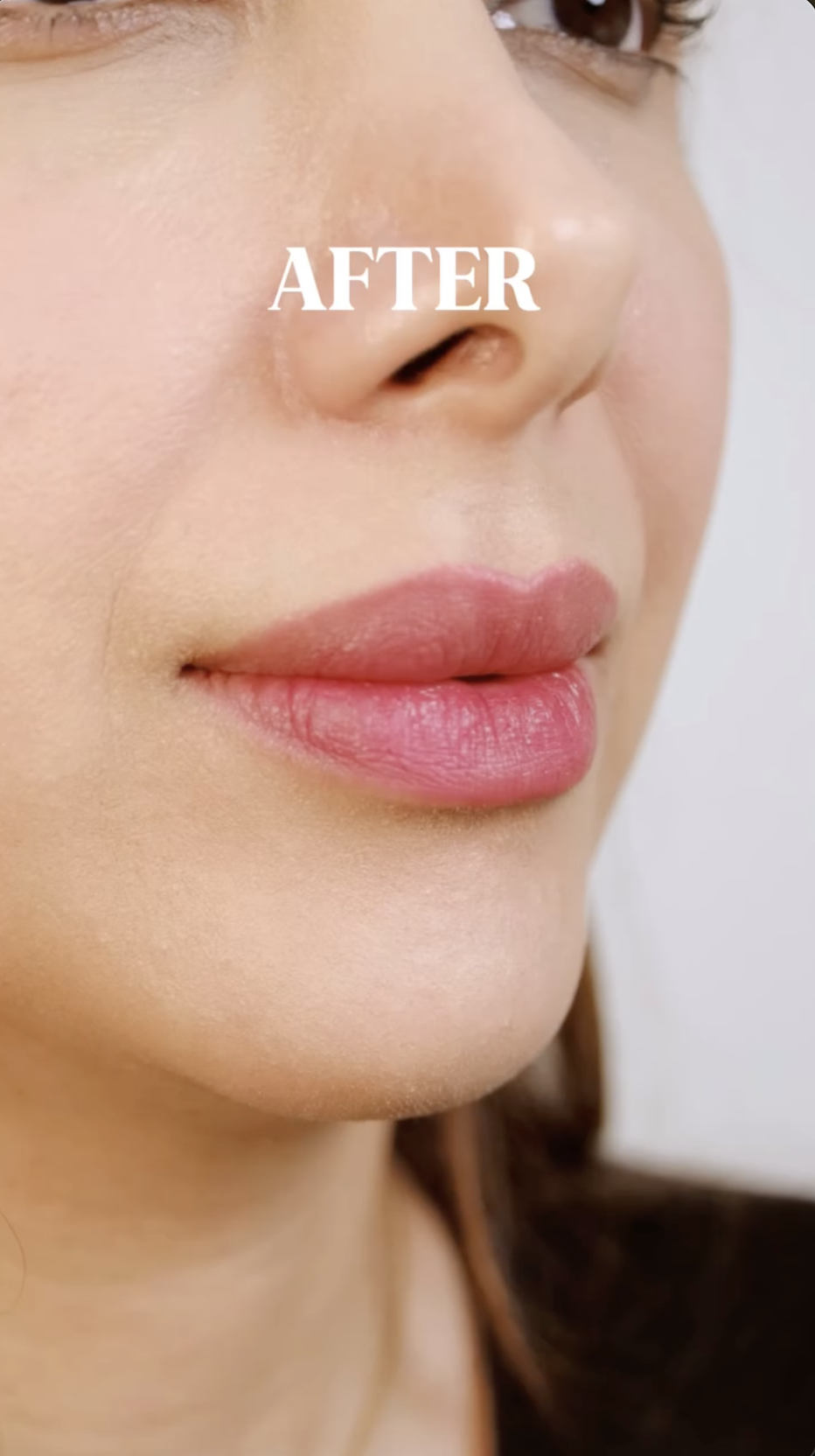 Lip Filler · Dr. Azmal Signature, after