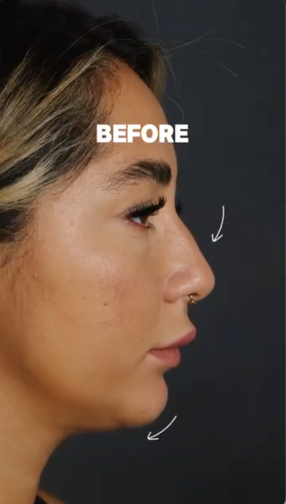Non-Surgical Nose Job, before