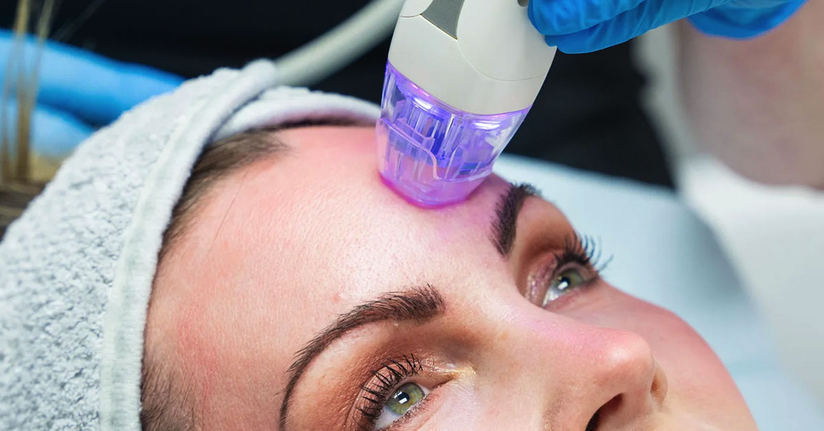 RF Microneedling treatment with Dr. Azmal