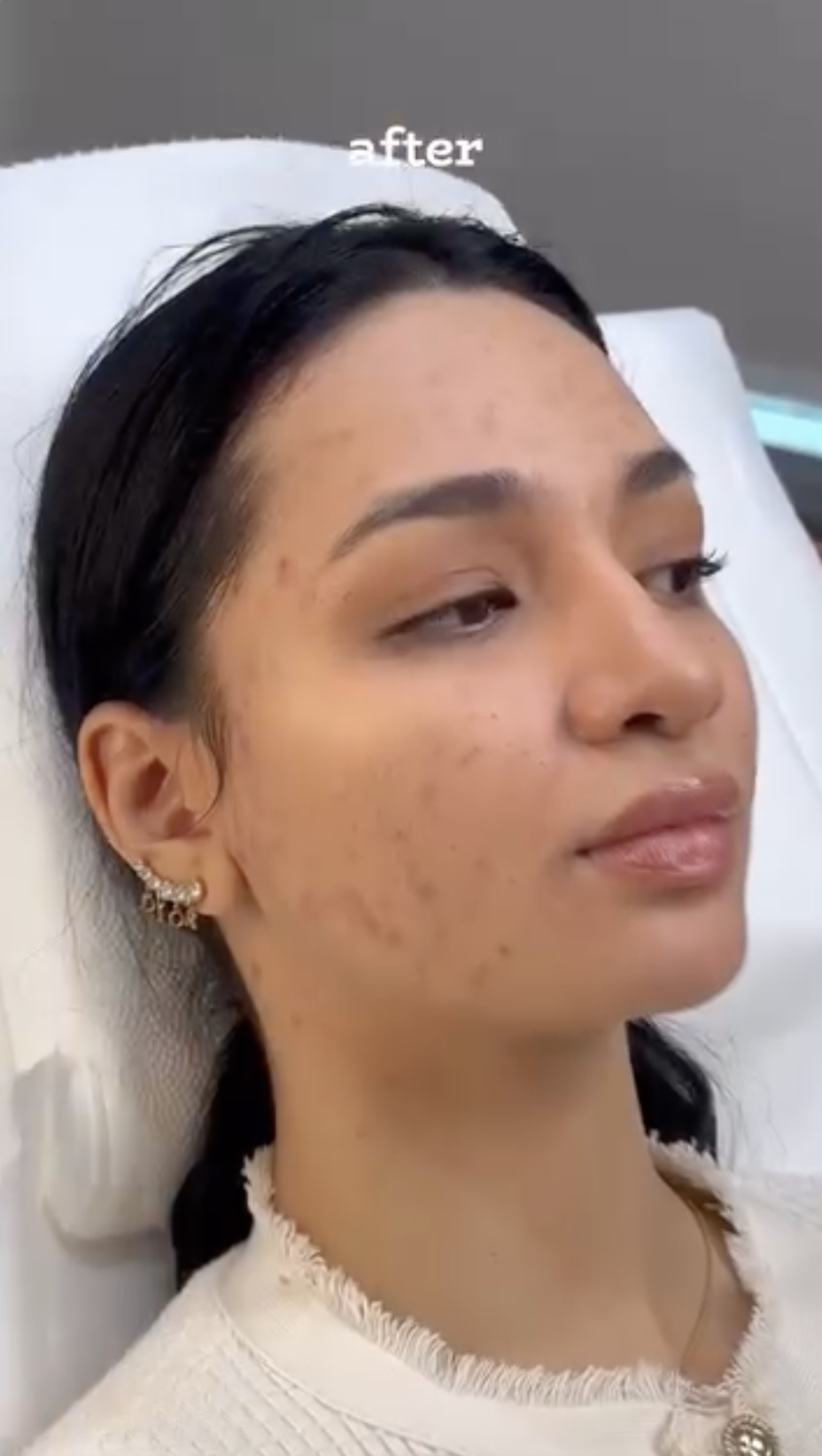Acne Treatment, after