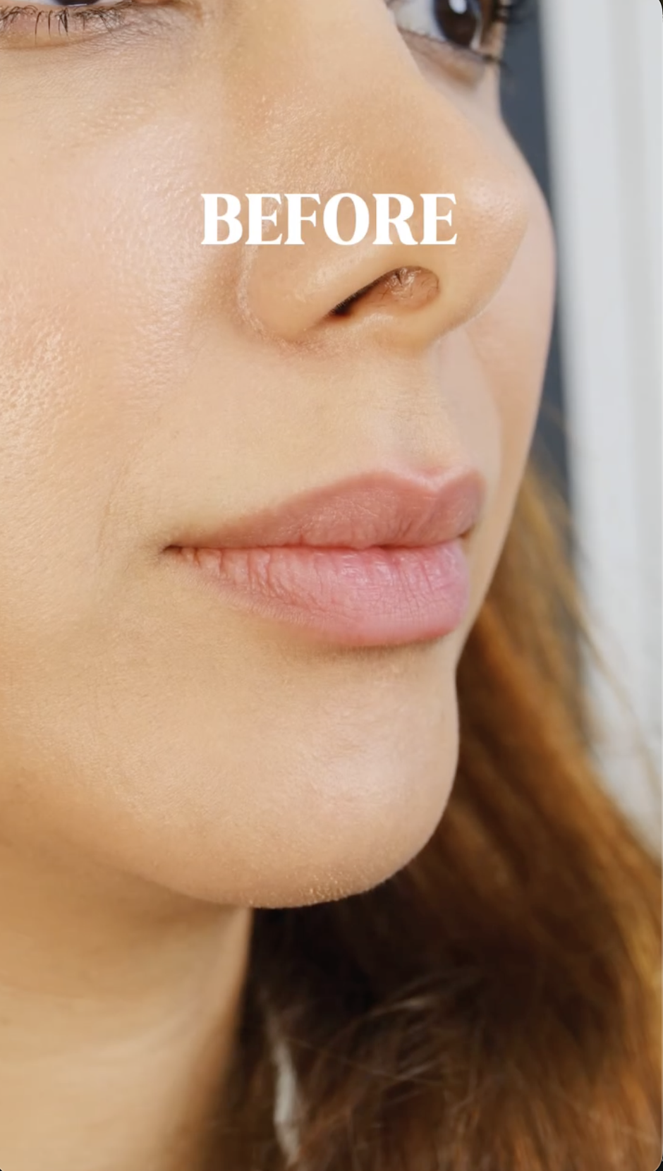 Lip Filler · Dr. Azmal Signature, before